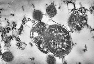 F,49y. | phagocytosed microbes - purulent meningitis F,49y. | phagocytosed microbes - purulent meningitis